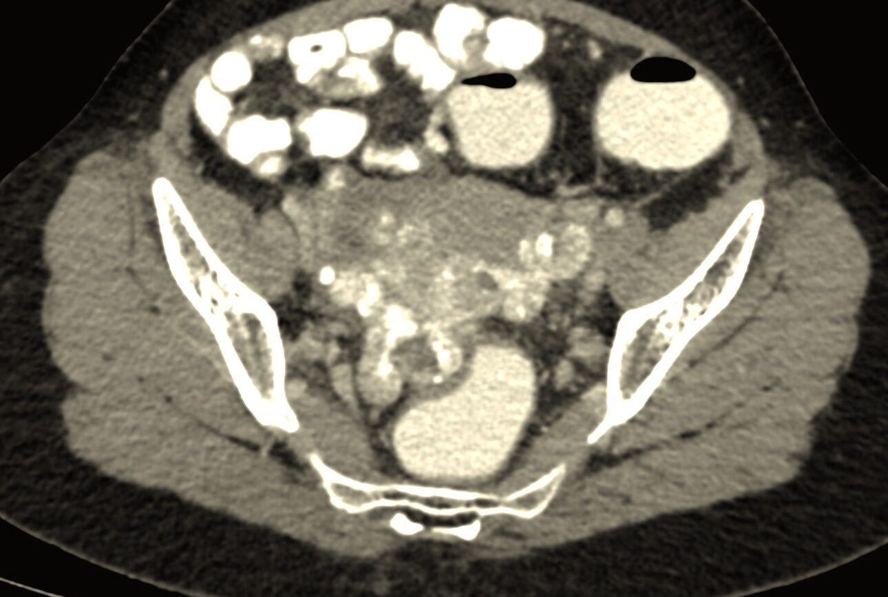 Desmoplastic small round cell tumors