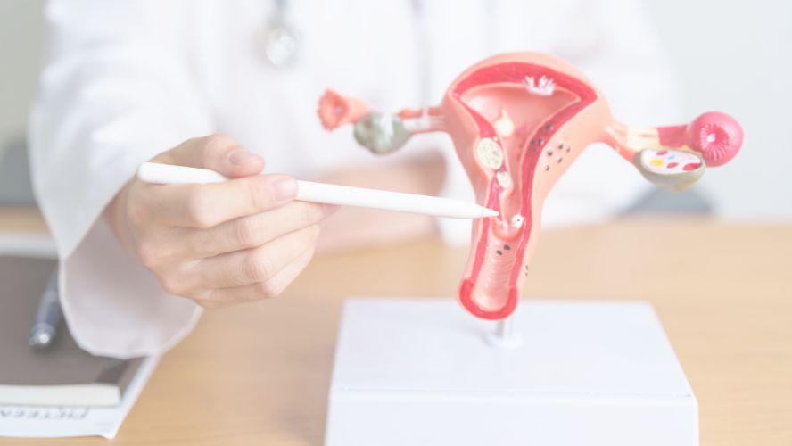 Common Ovarian Cancer Myths vs Facts Debunked